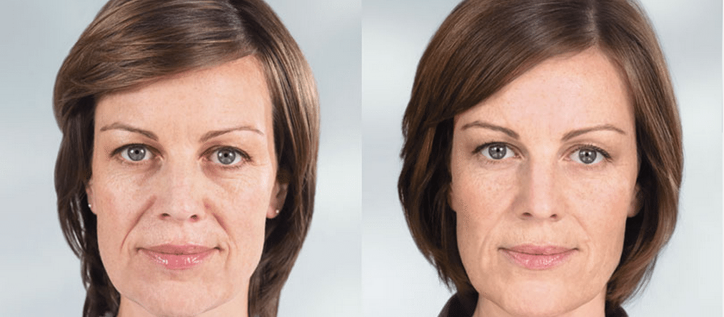Sculptra: Restoring the Natural Volume of Your Face